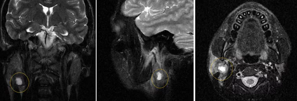 МРТ слюнных желез - снимки