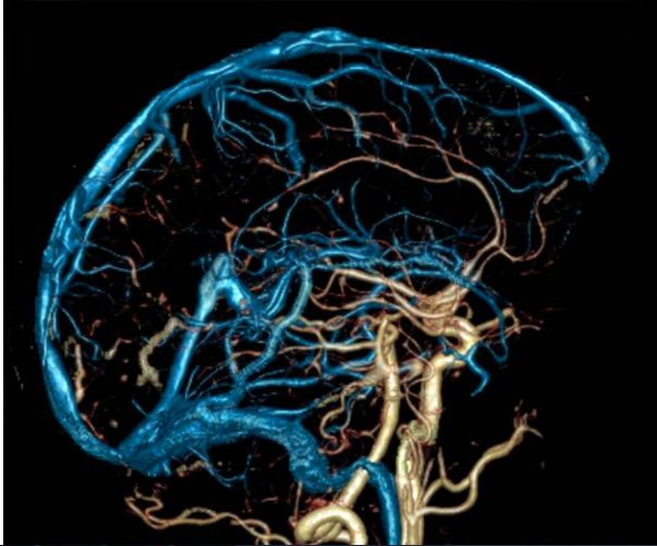МР-ангиография вен головного мозга - диагностика