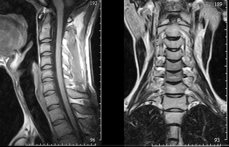 МРТ шейного отдела позвоночника - снимки профиль и анфас
