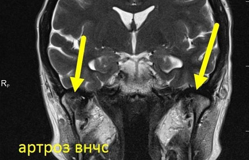 Артроз ВНЧС на МРТ