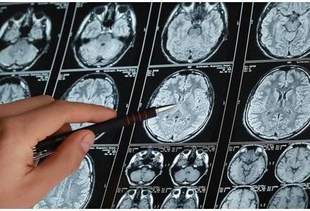 Снимки МРТ головного мозга