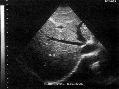 Дуплексное сканирование сосудов печени - снимки