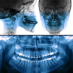 Ортопантомограмма (панорамный снимок) - что показывают снимки