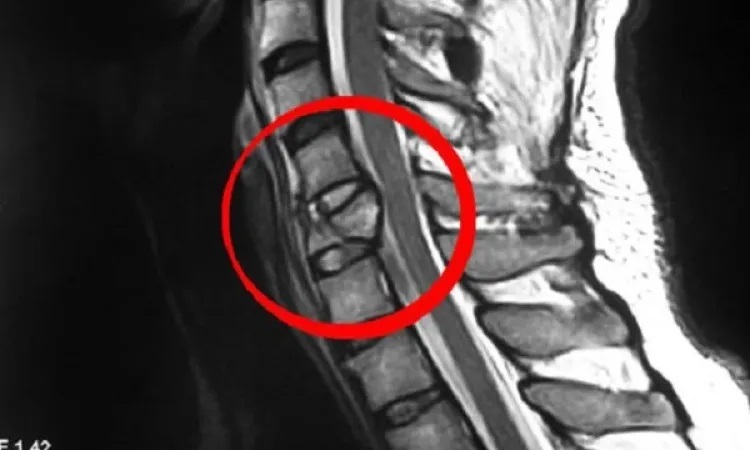 Перелом позвонка на МРТ позвоночника