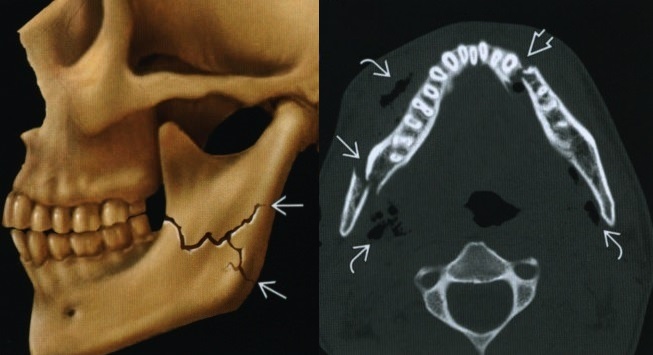 Перелом челюсти на КТ