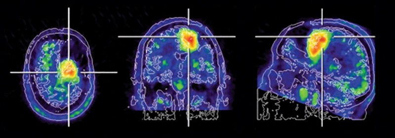 ПЭТ-КТ крупных сосудов головного мозга - снимки