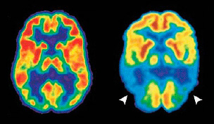 ПЭТ-КТ головного мозга - снимки