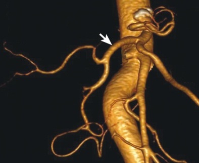 МР-ангиография чревного ствола - диагностика
