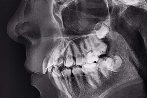 Рентген челюсти - диагностика