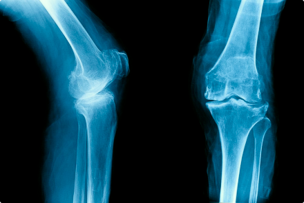 Рентген коленного сустава - диагностика