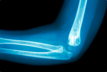 Рентген локтевого сустава - диагностика