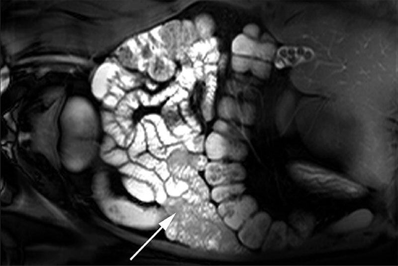Рак кишечника на снимках МРТ