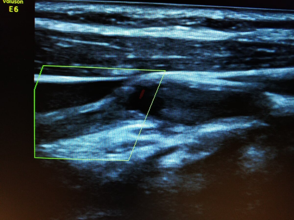 Окклюзия сосуда на УЗДС - снимок