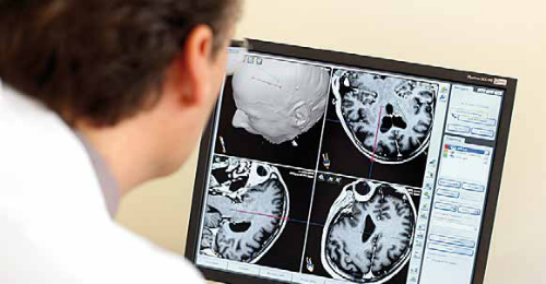 опухоль мозга на МРТ
