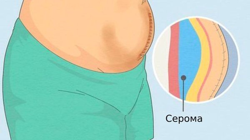 Серома после операции.