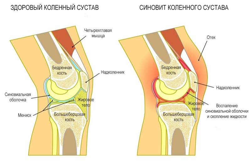 Строение здорового колена и при синовите, схема.