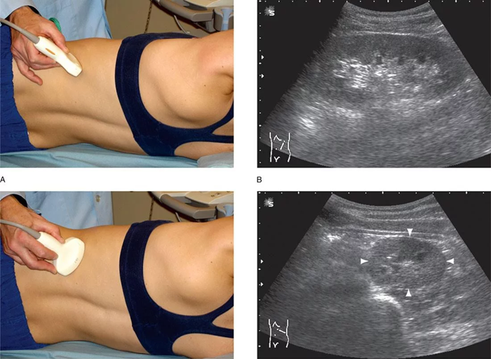 УЗИ почечных артерий - процедура и снимки