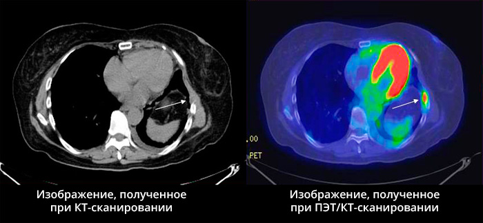 ПЭТ-КТ оценки жизнеспособности миокарда - снимки