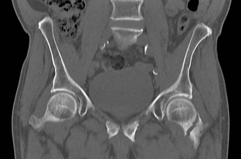 КТ тазобедренного сустава - что показывают снимки