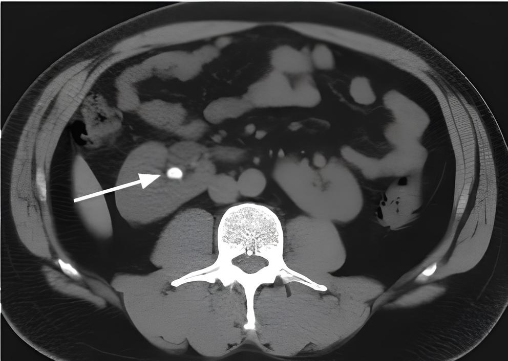 Камень в почке на снимке КТ с контрастом