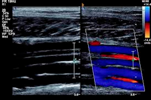 УЗДГ артерий нижних конечностей - снимки