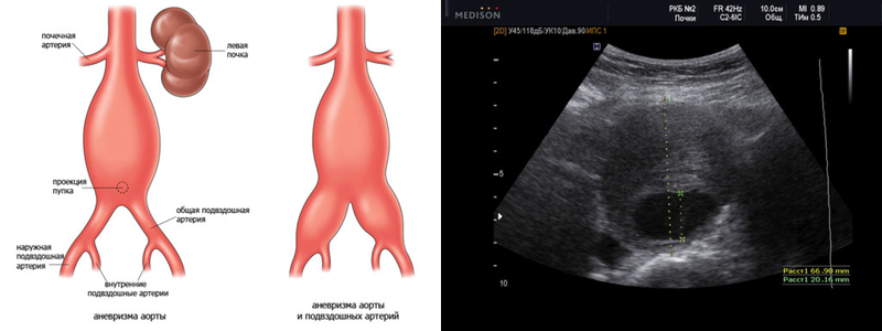 Аневризма брюшной аорты на УЗДГ