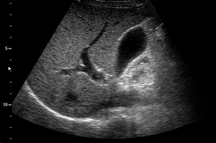 Снимки УЗИ печени и желчного пузыря.