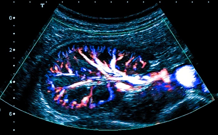 УЗДГ сосудов почек - снимки.