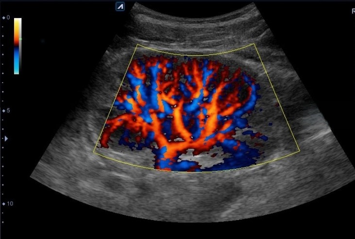УЗДГ почечных сосудов - снимки.