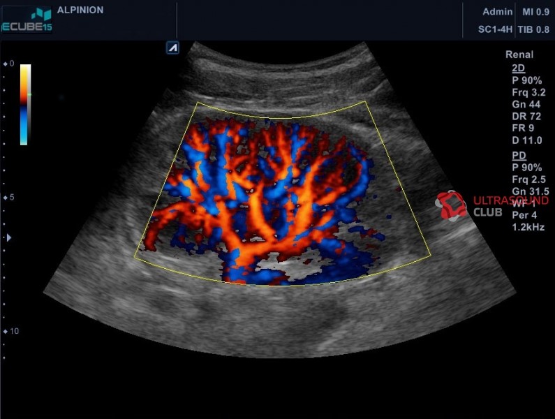 УЗИ почечных артерий - снимки