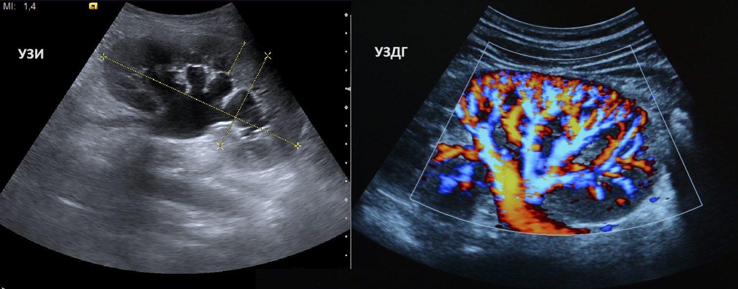 Сравнение снимков УЗИ и УЗДГ почки