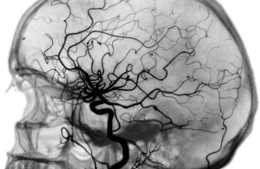 Рентгеновская ангиография сосудов головного мозга