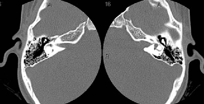 КТ внутреннего и среднего уха - снимки