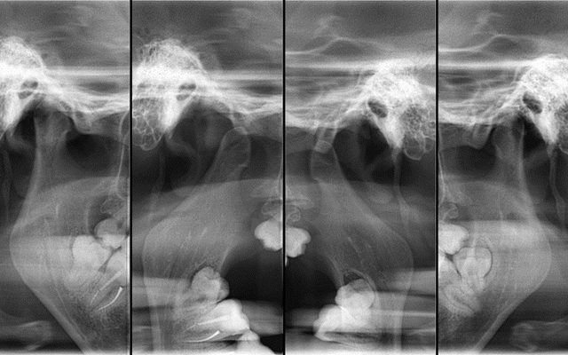 Рентген височно-нижнечелюстного сустава - снимки